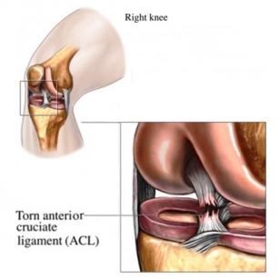 ACL Injury